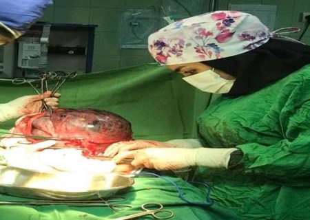 خارج کردن توده ۵ کیلویی از شکم مادر باردار