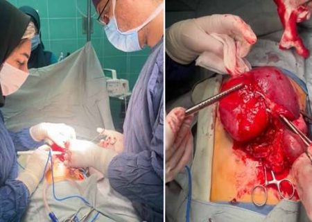 خارج کردن تومور شکمی از بدن کودک ۱۰ساله در مرکز آموزشی و درمانی ۱۷ شهریور رشت